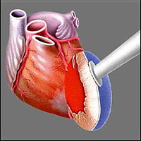     -   Heart Laser,     ,      