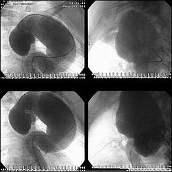 Аневризма аорты - ангиограмма аневризмы всей грудной аорты: поражены восходящая и нисходящая части и дуга аорты 