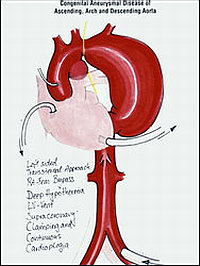 Аневризма аорты - Схема операции по протезированию аневризмы, показанной на ангиограмме (рис. 2). АИК подключается к бедренной артерии, сердце разгружается с помощью вента 