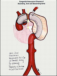 Аневризма аорты - Результат операции по одновременному протезированию восходящей части аорты, дуги и нисходящей части 