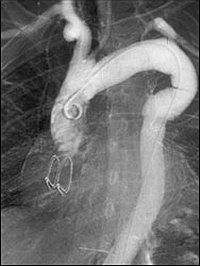 Аневризма аорты - Ангиограмма, сделанная спустя несколько месяцев после операции 