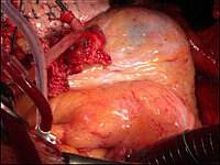Аорто-коронарное шунтирование: Наложение анастомоза между внутренней грудной артерией и передней межжелудочковой ветвью левой коронарной артерии. Сердце остановлено, больной находится на аппарате искусственного кровообращения