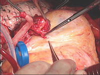 Аорто-коронарное шунтирование: Анастомоз между внутренней грудной артерией и передней межжелудочковой ветвью левой коронарной артерии готов. Хорошо видно улучшенное кровоснабжение передней стенки левого желудочка после снятия зажима с внутренней грудной артерии 