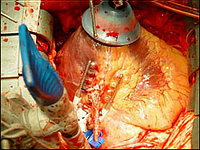 Аорто-коронарное шунтирование: Наложение анастомоза на бьющемся сердце между левой грудной артерией и передней межжелудочковой ветвью левой коронарной артерии с помощью специального стабилизатора