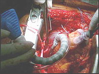 Аорто-коронарное шунтирование: Наложение анастомоза на бьющемся сердце между венозным шунтом и одним из сосудов отходящих от огибающей ветви левой коронарной артерии 