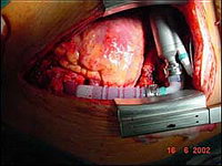Имплантация искусственного сердца - ИНКОР показан в момент операции 