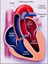 Хирургическое лечение пороков сердца - Показано состояние до операции 