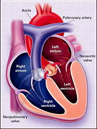 Хирургическое лечение пороков сердца - Состояние после перестановки аорты и пульмональной артерии в анатомически правильные положения 