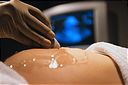 ЭКО ( IVF ) - экстракорпоральное оплодотворение с последующим переносом эмбрионов в матку матери 