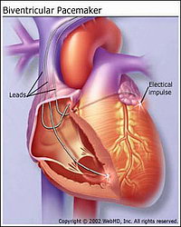Нарушения ритма сердца - Схема установки электродов в сердце 