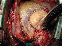 Операция коронарного шунтирования: Венозный шунт между правой коронарной артерией и аортой. Сердце уже работает, но больной ещё находится на аппарате искусственного кровообращения