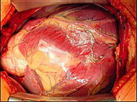 Пересадка сердца - Больное сердце перед подключением на аппарат искусственного кровообращения (АИК) 