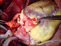 Пересадка сердца - Хирург производит сшивание лёгочных артерий донора и реципиента 