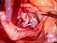 Искусственные клапаны сердца - Вид на кальцифицированный аортальный клапан со стороны разреза восходящей аорты 